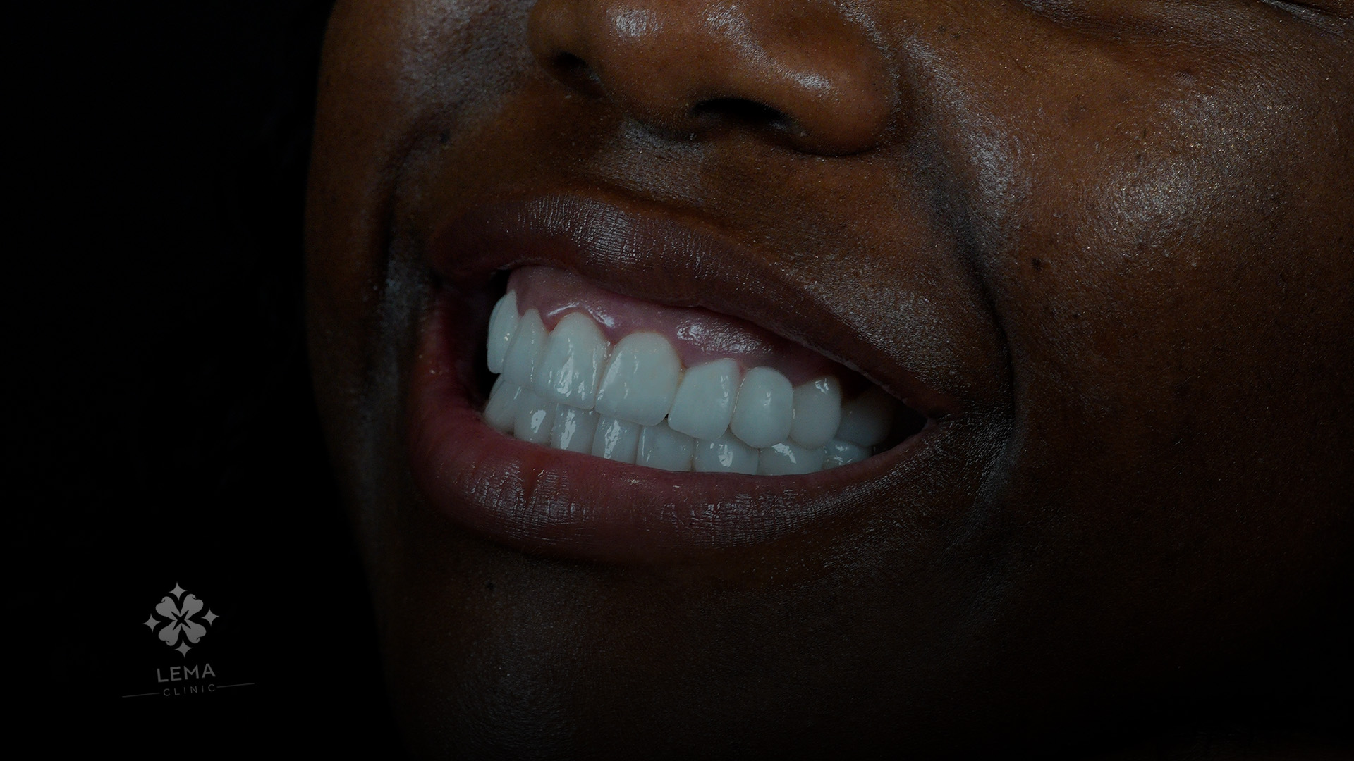 защо се извършва операция за gummy smile